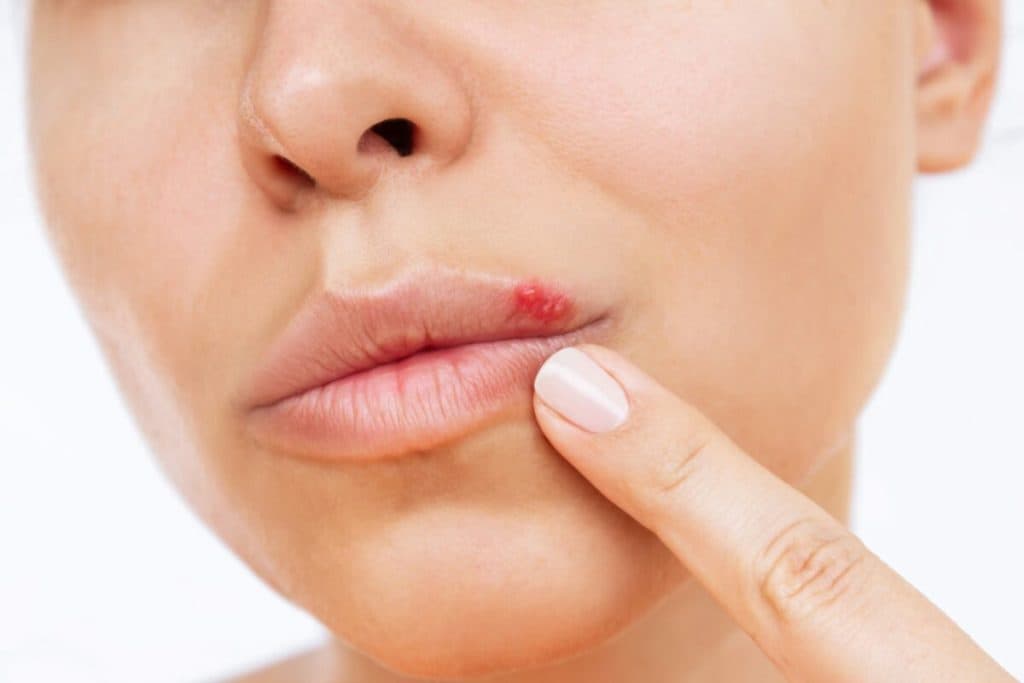 Herpes: Soluții naturale pentru reducerea simptomelor și grăbirea procesului de vindecare