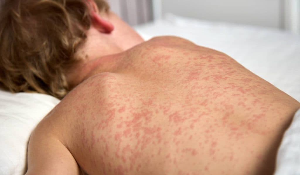 Motivul creșterii incidenței dermatitei atopice: „20% dintre bebeluși pot dezvolta dermatită atopică în primii ani de viață”