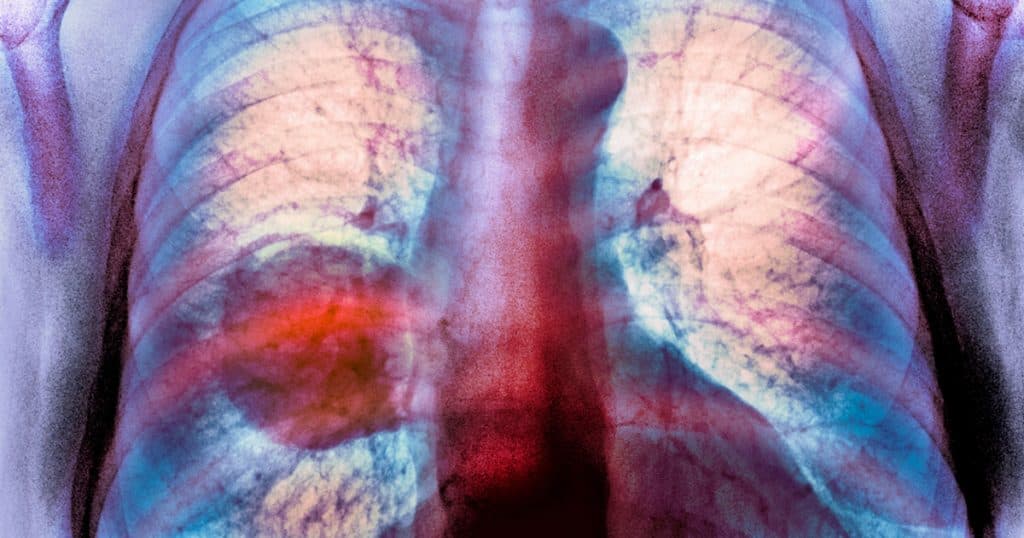 Creșterea diagnosticului de cancer pulmonar în rândul nefumătorilor