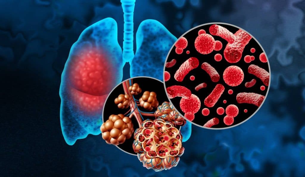 Gripa este responsabilă pentru 25% din cazurile de agravare a bolilor pulmonare cronice. „Modificările apărute în căile respiratorii sunt mult mai greu de gestionat și tratat.”