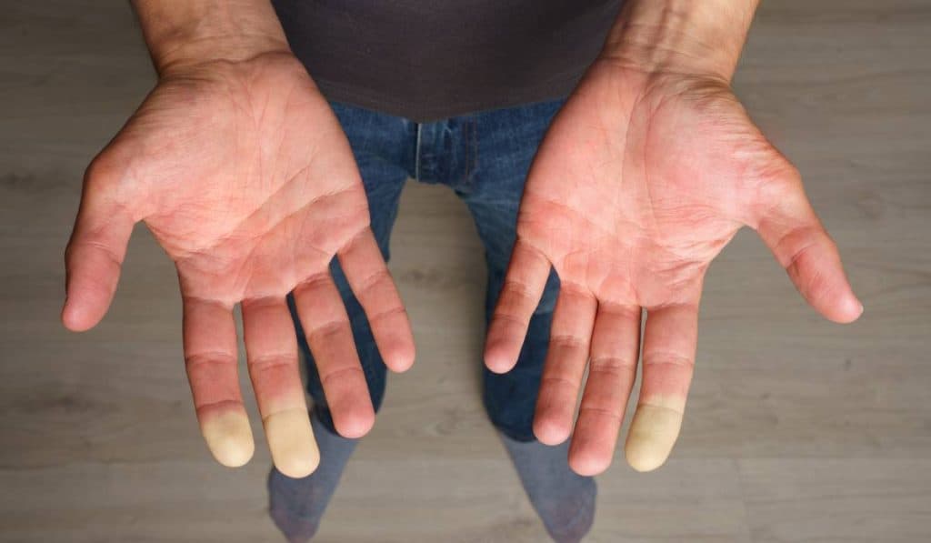 Mâinile și picioarele reci indică o carență serioasă. Ce mineral îți lipsește din organism?