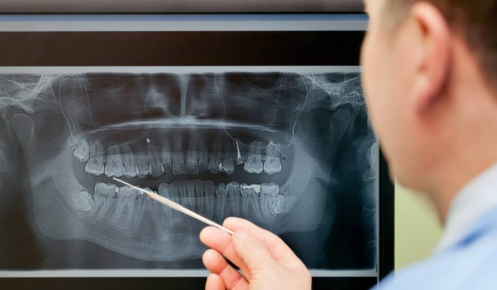 Mai mult de 50% dintre românii de peste 40 de ani au lucrări dentare cu plombe de mercur, o tehnică riscantă, interzisă în UE începând cu anul 2025.