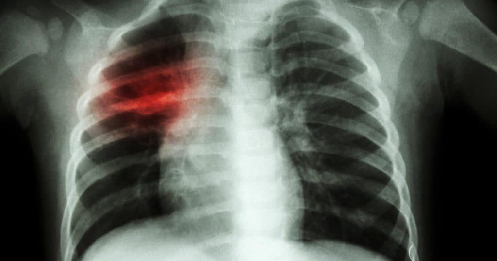 Creștere îngrijorătoare a cazurilor de tuberculoză în rândul copiilor din Europa și Asia Centrală. OMS solicită acțiuni imediate.