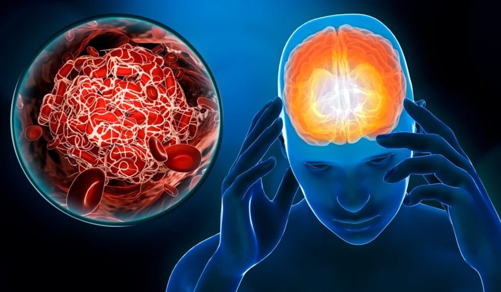 Două suplimente pe care nu ar trebui să le combini niciodată, deoarece cresc riscul de accident vascular cerebral.