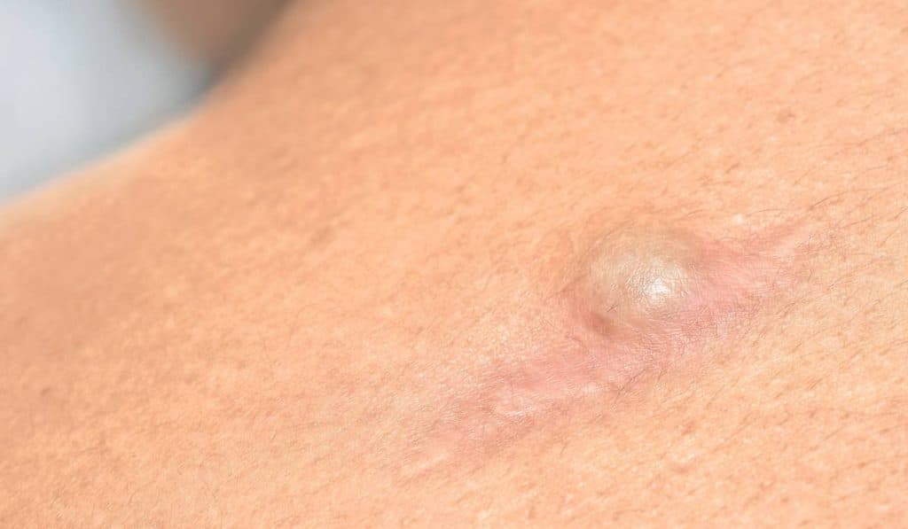 Eroarea care provoacă reapariția chistului sebaceu