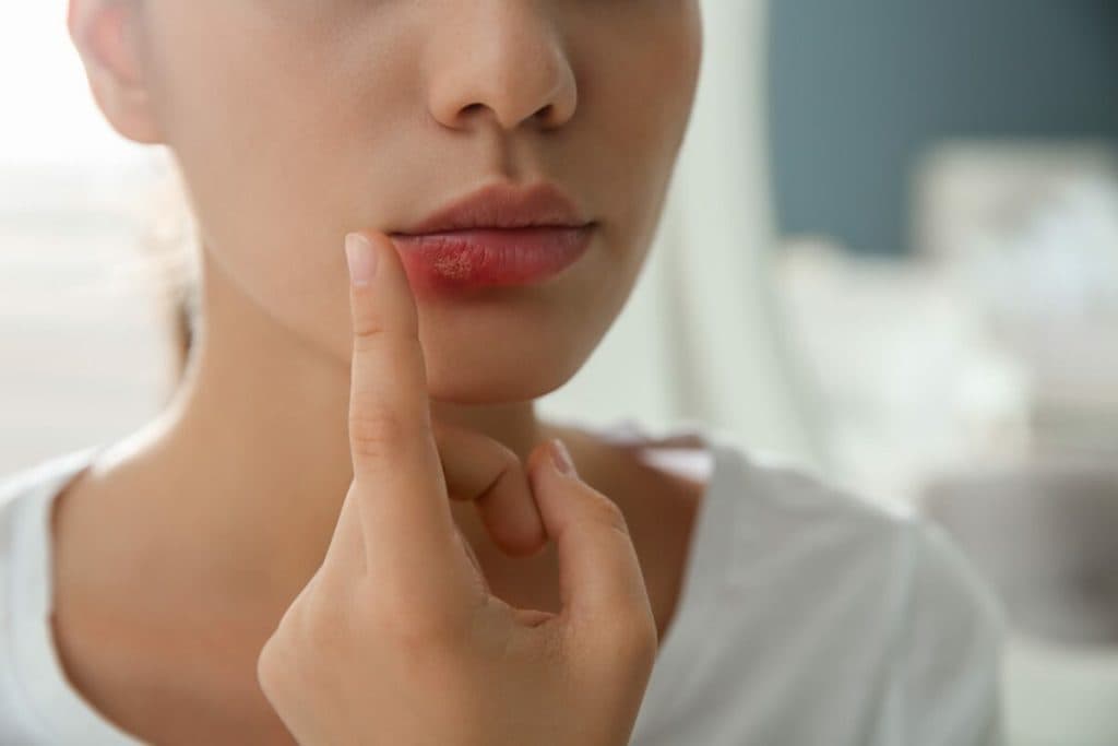 Herpesul bucal: Durata contagiozității și metode de prevenire a răspândirii
