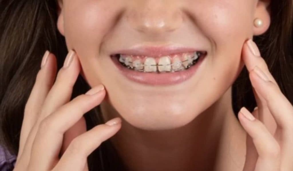 Aparatul dentar și estetica facială: Cum poate îmbunătăți trăsăturile feței tale
