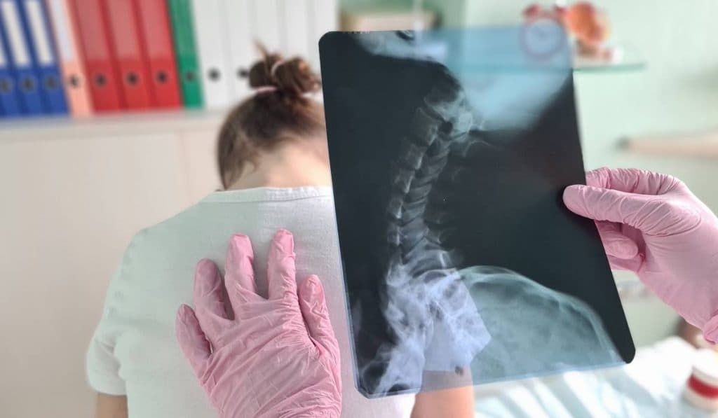 Scolioza în rândul copiilor: cauze, diagnostic și tratament