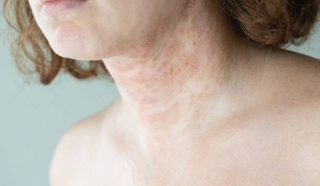 Soluții delicate pentru dermatita atopică