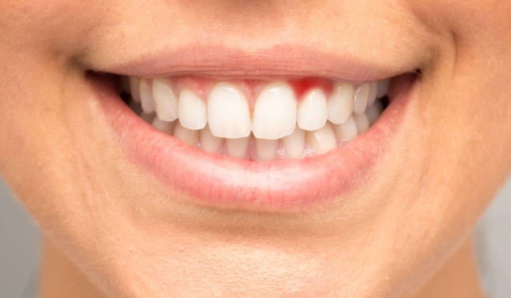 Ce deficiențe pot apărea dacă îți sângerează gingiile sau îți apar afte