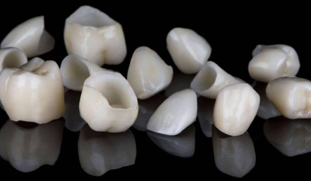 (P) Coroanele dentare detaliate: informații esențiale despre fiecare tip