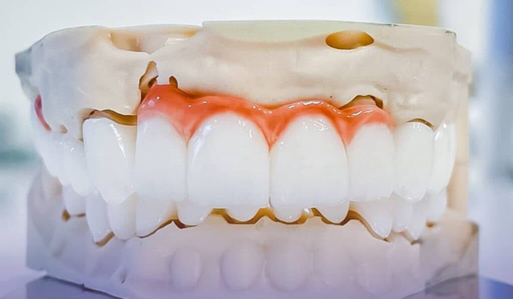 Estetică fără compromis: Motivele pentru care implantul dentar reprezintă cea mai naturală soluție