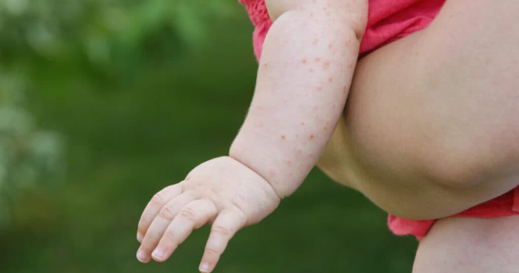 România a înregistrat peste 1.000 de cazuri de rujeolă în luna mai, iar județul cu cele mai multe îmbolnăviri.