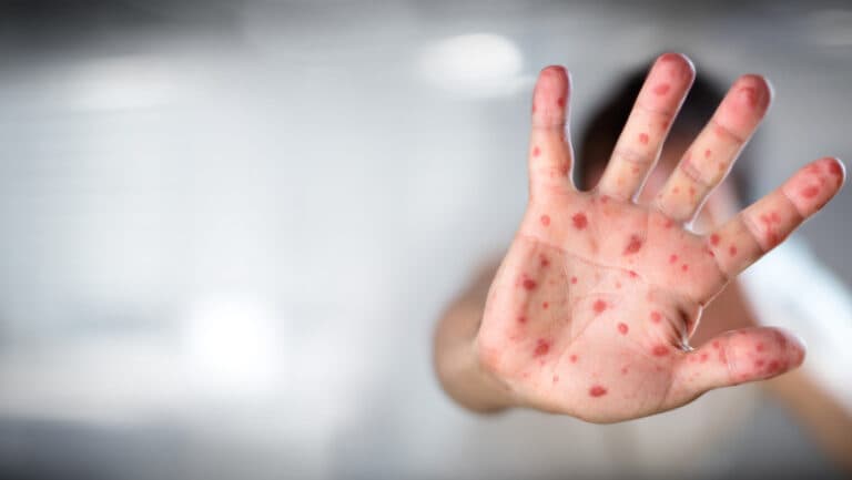 Tragedia pierderii unui copil din cauza rujeolei a generat o furtună de teorii antivacciniste în Marea Britanie.