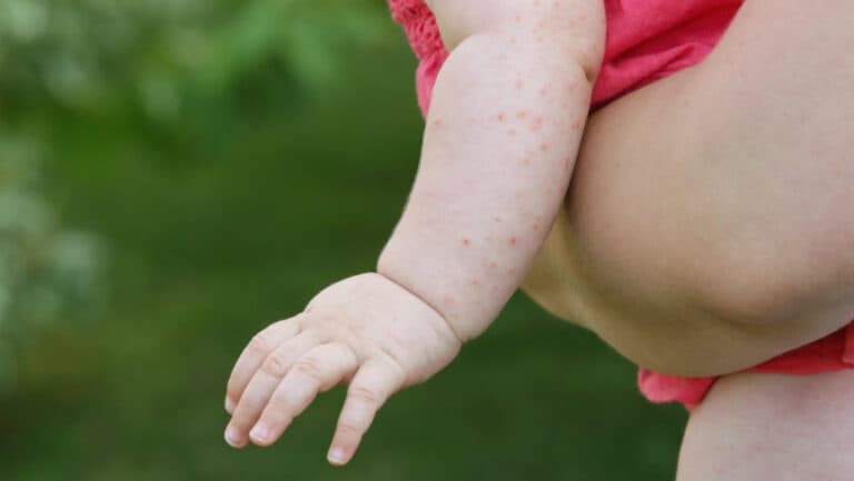 SUA traversează cea mai severă epidemie de rujeolă din ultimele două decenii, cu acuzații împotriva secretarului de stat Robert Kennedy Jr.