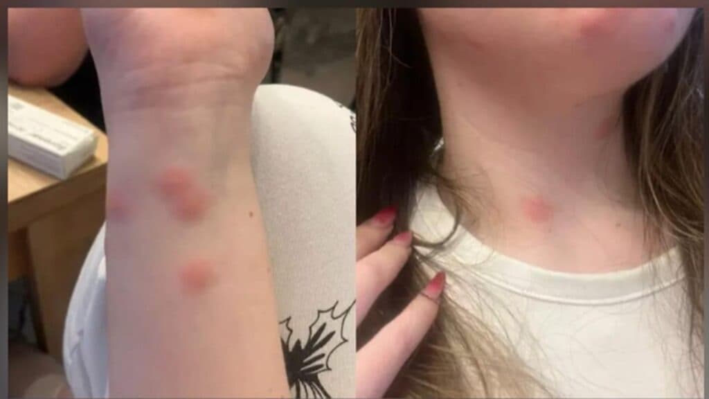 Îngrozitoare condiții în trenul București–Sighet: O tânără a necesitat îngrijiri medicale după ce a fost mușcată de ploșnițe într-un vagon cușetă
