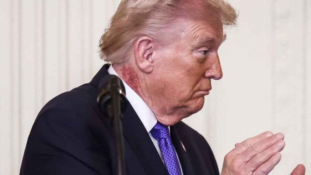 Secretul „petei rubinii” a lui Trump, dezvăluit de specialiști: Cât timp va rămâne liderul american marcat de iritația de pe gât